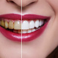 The Evolution of the Teeth Whitening Best Method