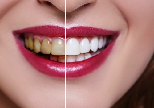 The Evolution of the Teeth Whitening Best Method
